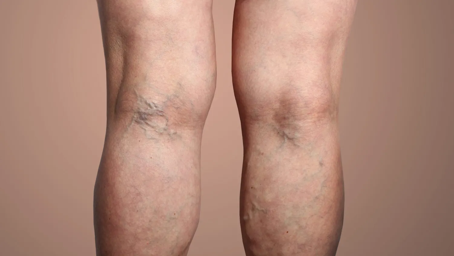 varicose-veins-explained-symptoms-causes-and-care